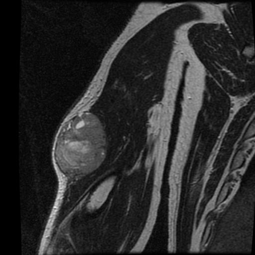 Sarcoma Arm